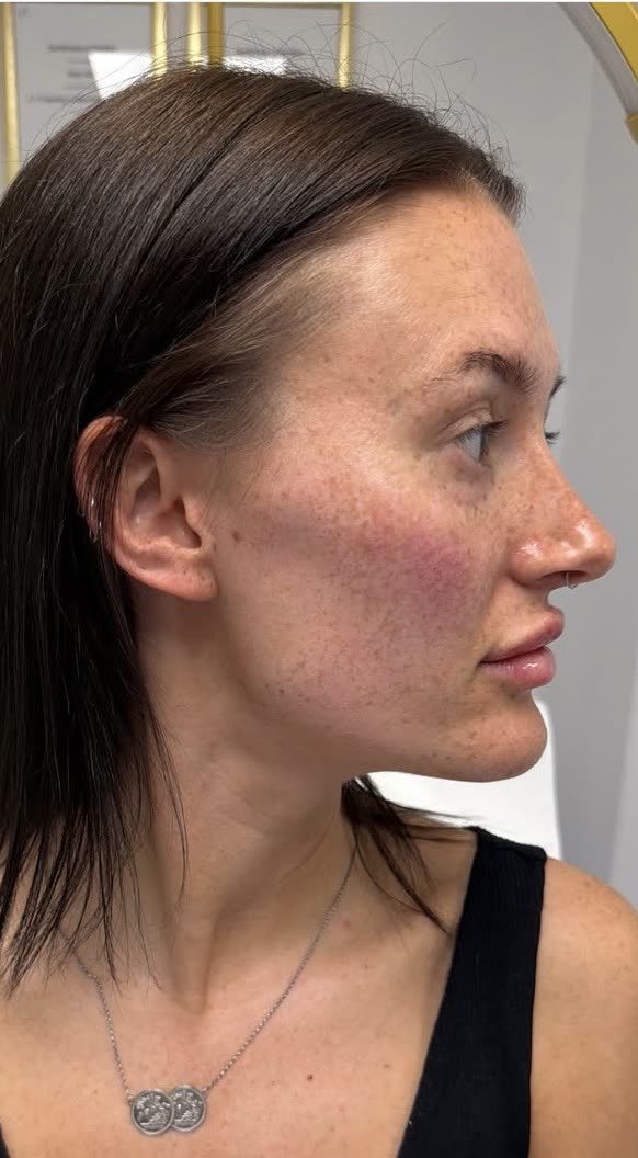 Jawline and Cheek Enhancement: after