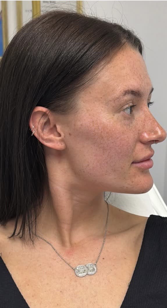 Jawline and Cheek Enhancement: before