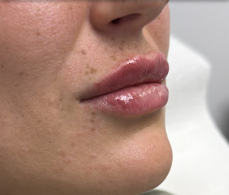 Lip Filler: after
