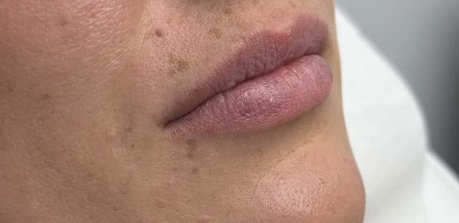 Lip Filler: before